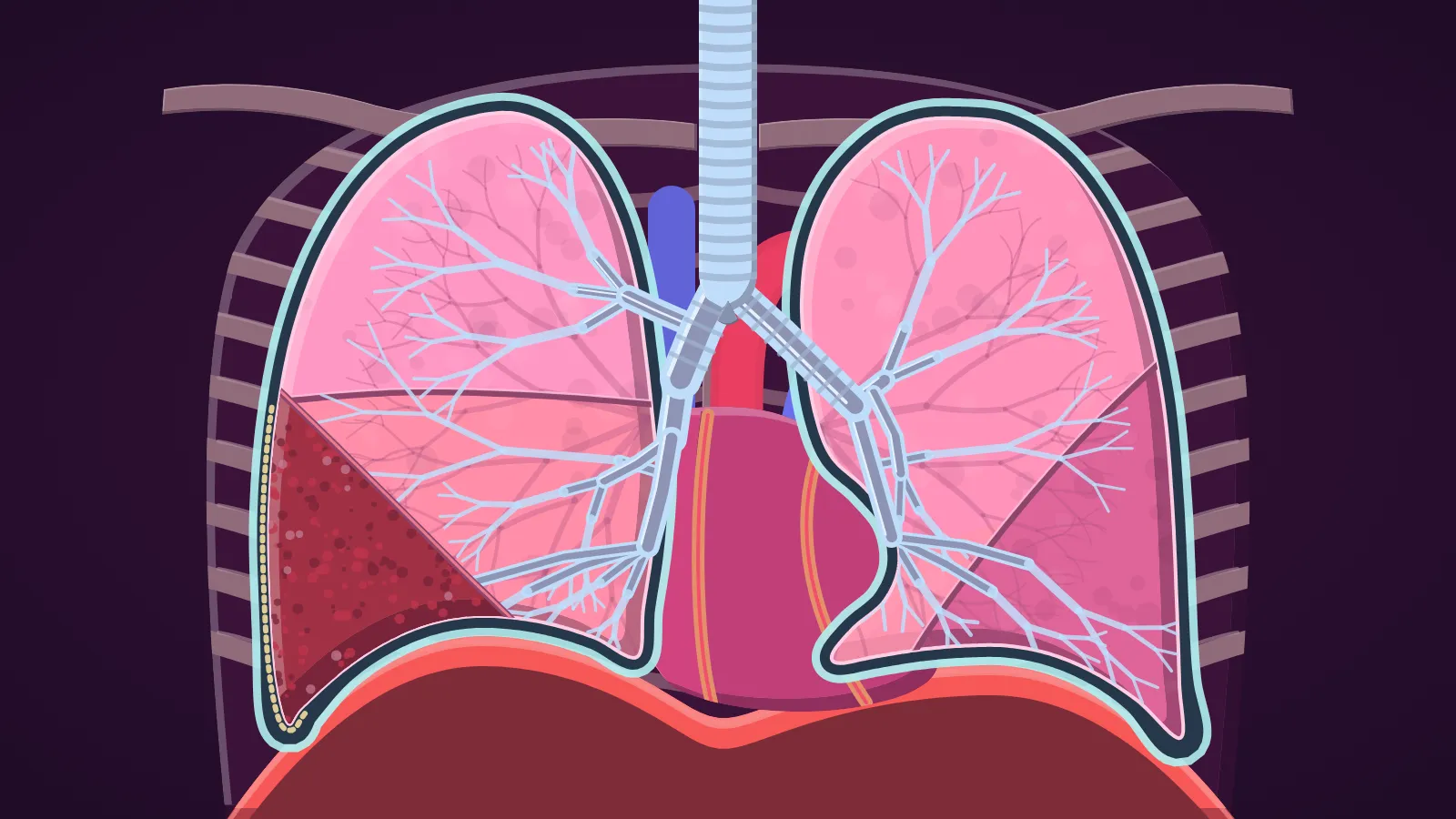 Illustration of the lungs with lobar consolidation filling one lobe